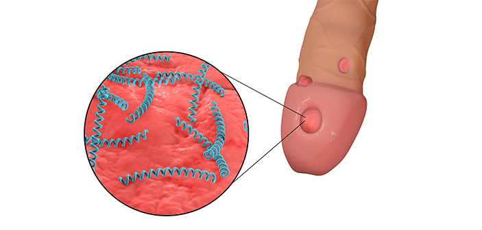 Penis svampeinfektion SVAMP PÅ